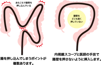 痛みを最小限にする内視鏡の挿入法