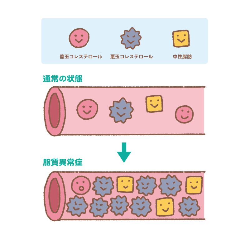 脂質異常症と動脈硬化