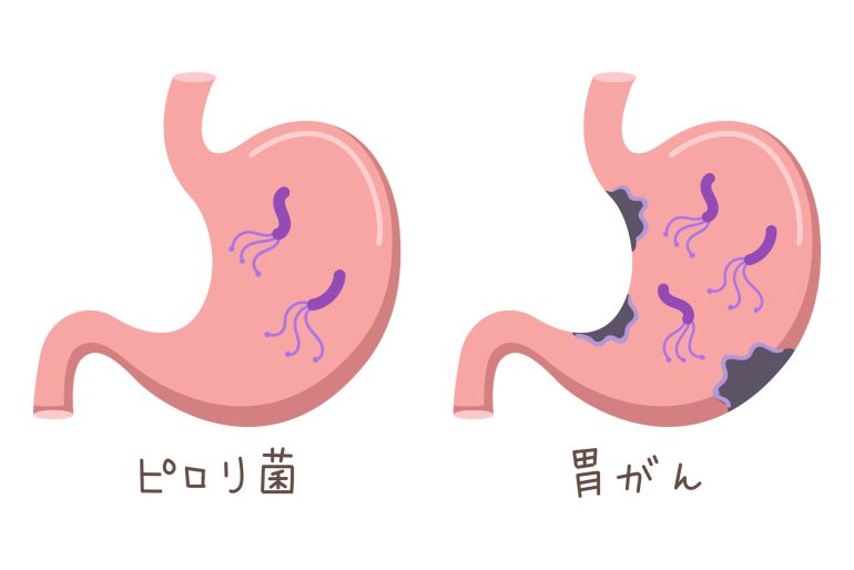 ピロリ菌と胃がん